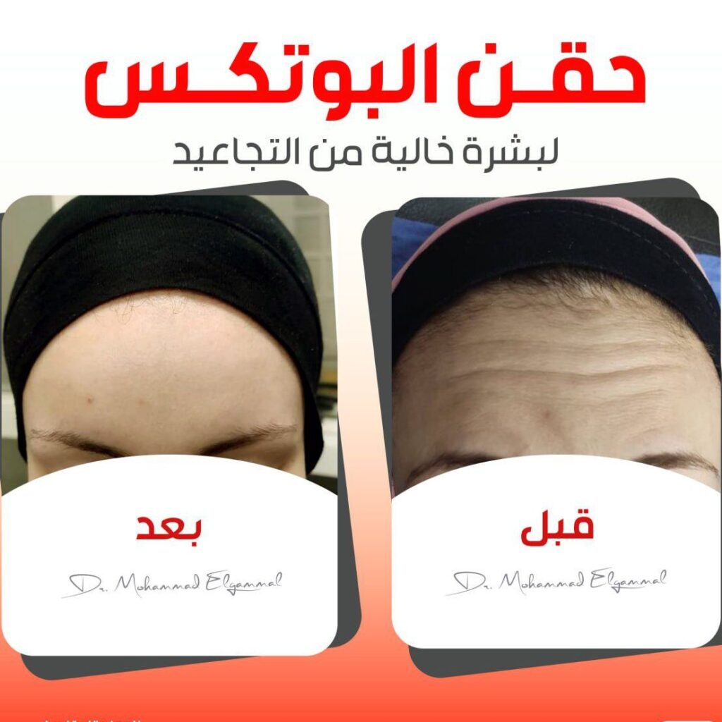 نتيجة البوتوكس — قبل وبعد